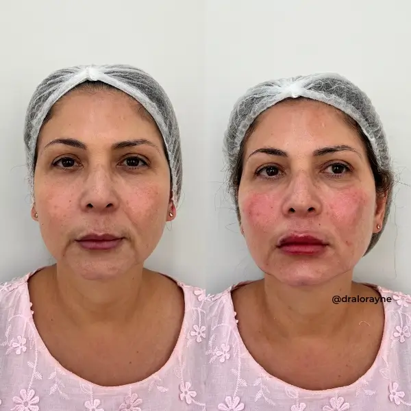 Resultado de realce facial natural